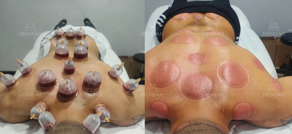 Hijama cups before and after applied to 19 traditional points on a client’s upper and lower back during wet cupping therapy