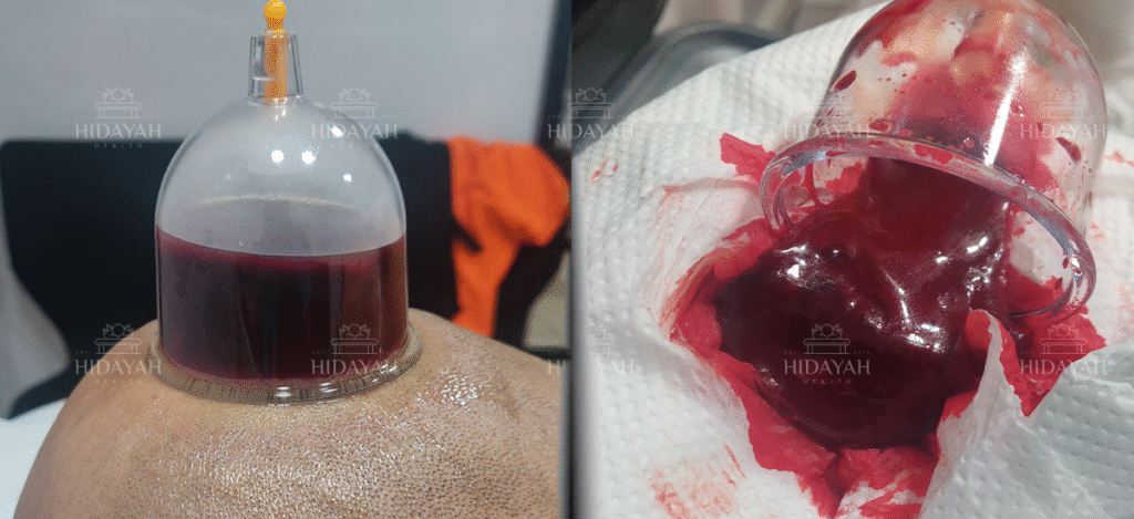 Hijama therapy head cupping cup showing coagulated blood after wet cupping session on client