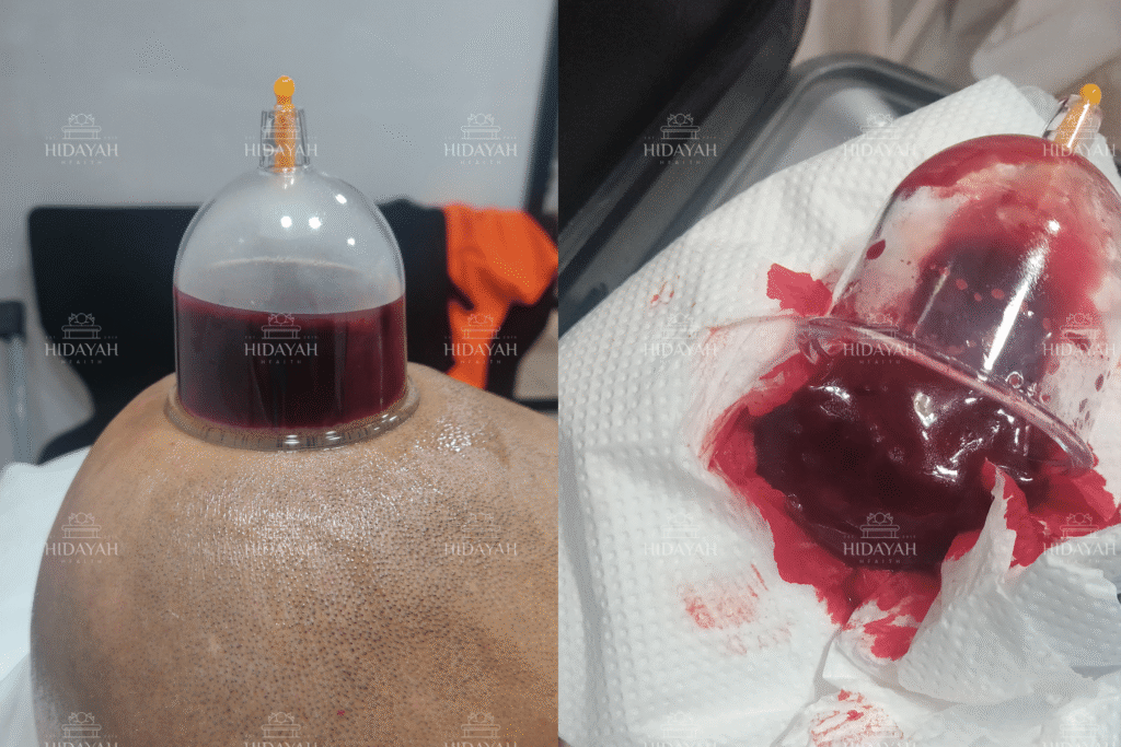 Hijama therapy head cupping cup showing coagulated blood after wet cupping session on client