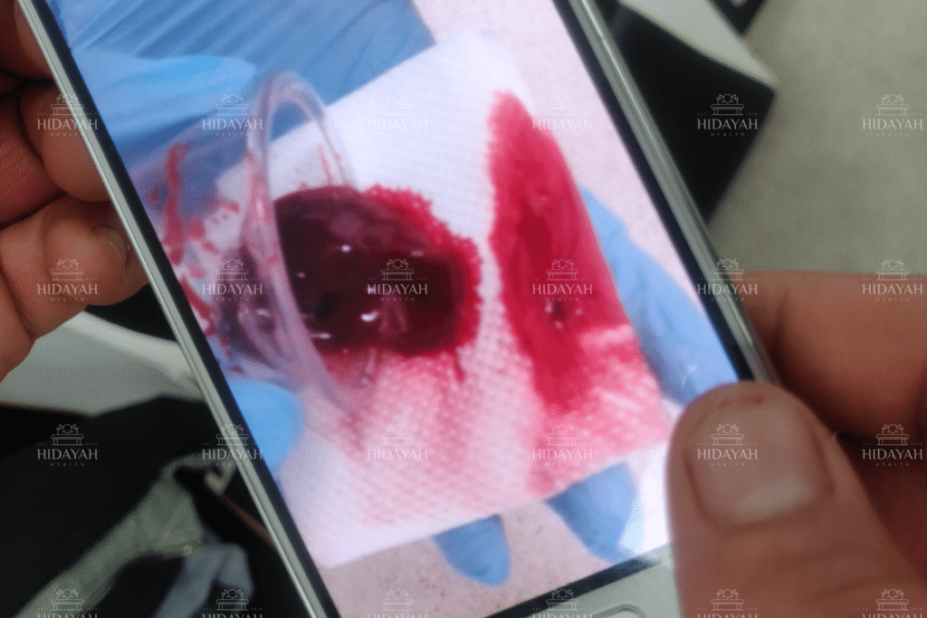 Hijama therapy head cupping cup showing coagulated blood after wet cupping session on client