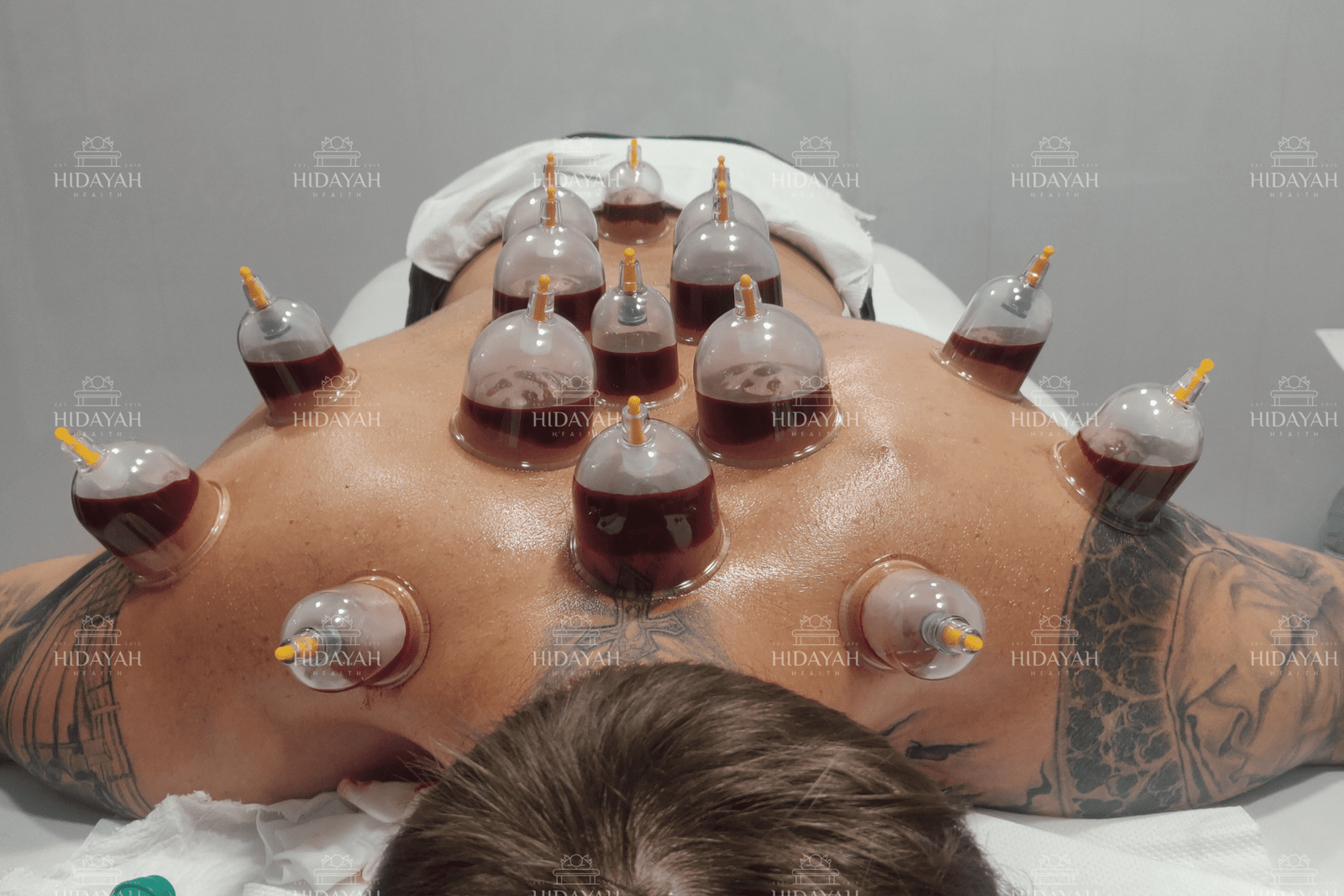 Learn Hijama training with ongoing graduate support. Hijama cups before and after applied to 19 traditional points on a client’s upper and lower back during wet cupping therapy