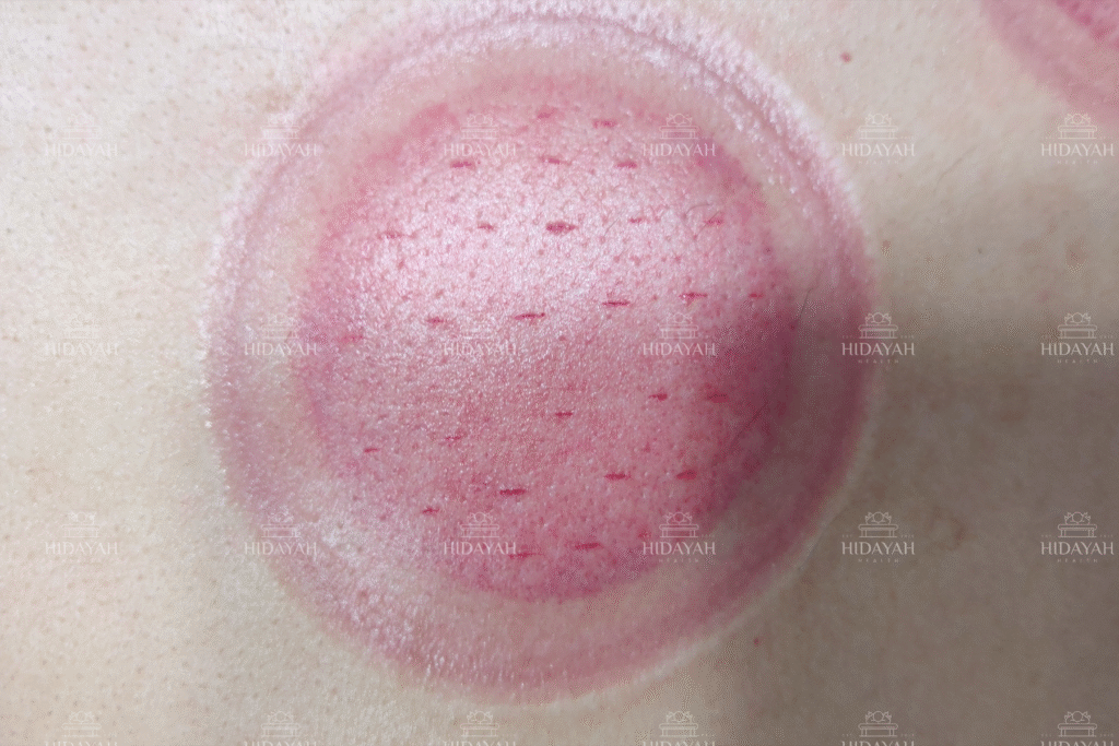 Neat and professional Hijama incisions after treatment showing ideal blade technique and clean healing lines