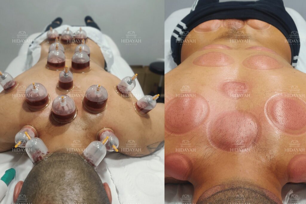 Hijama cups before and after applied to 19 traditional points on a client’s upper and lower back during wet cupping therapy